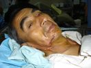 Man After Removal of Cancerous Tumor